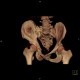 Fracture of pelvis, pubic bone, subluxation of sacrum, VRT: CT - Computed tomography